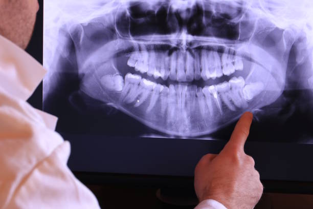 Best Broken or Chipped Tooth Repair in Springboro, OH